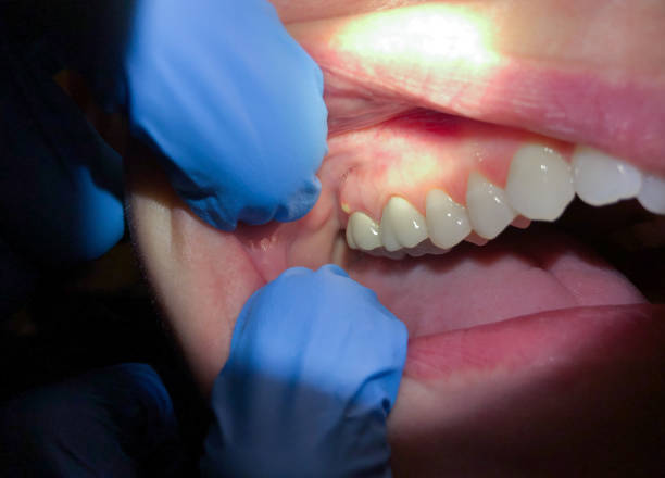 Best Emergency Treatment for Dental Infections or Abscesses in Rockwell, NC